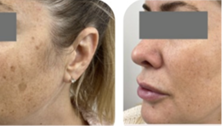 Behandlungsbeispiel Um Vorher Nachher Dermatologie Hanau